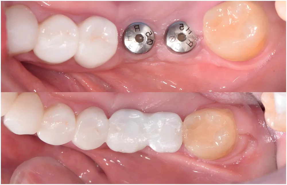 dental implants case