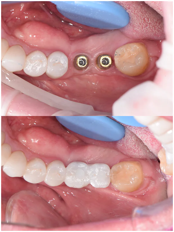 dental implants in China