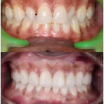 diastema veneers case
