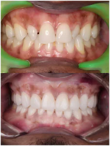 diastema veneers case