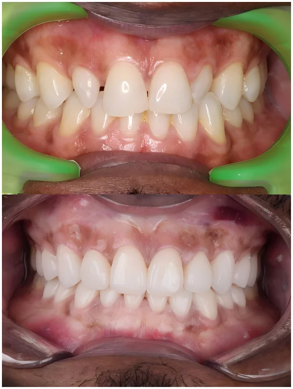 diastema veneers case