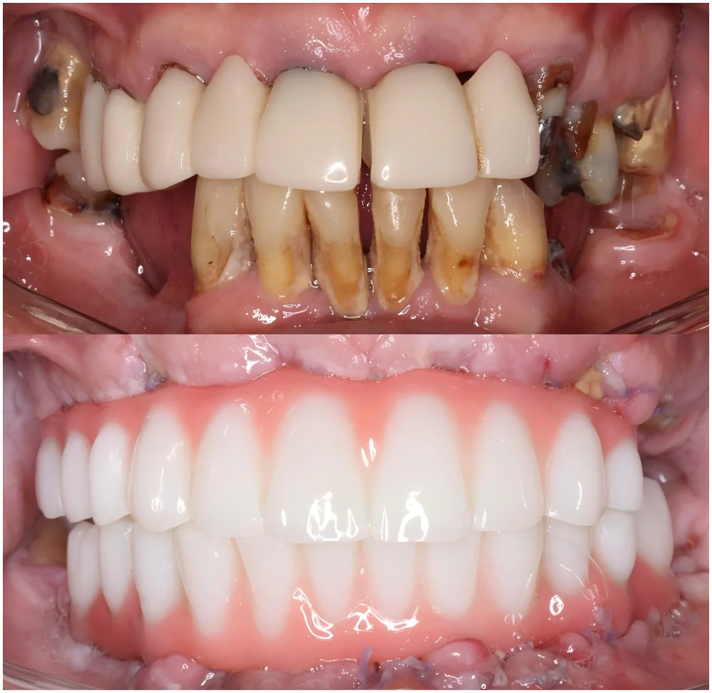 immediate loading dental implants