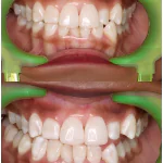 laser whitening in huangshan dental
