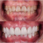 veneers tetracycline stained teeth