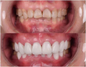 veneers tetracycline stained teeth