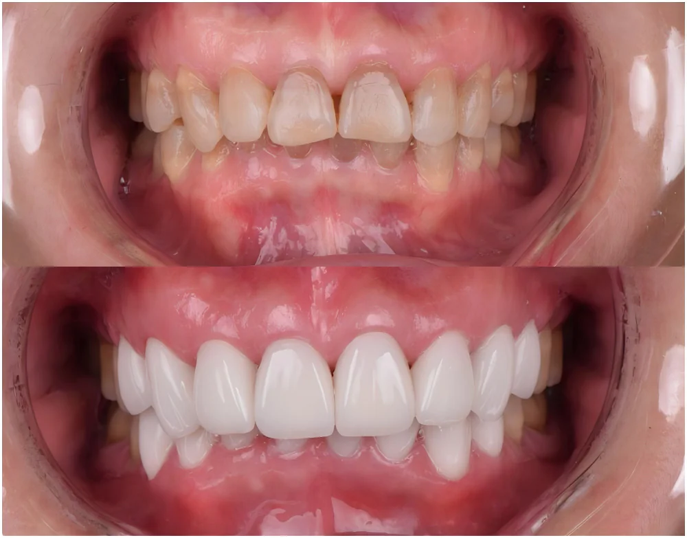 veneers tetracycline stained teeth