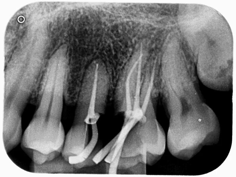 root canal