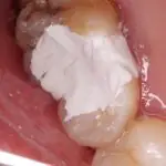 root canal