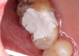 root canal