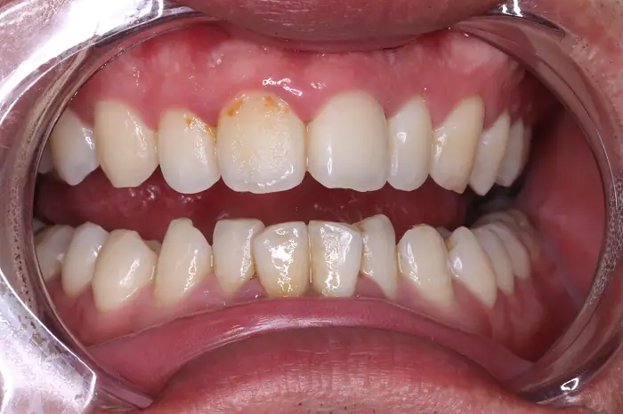 Yellow Teeth